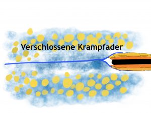 Abbau der Krampfader nach der Verödung mit Radiowellen oder Laser