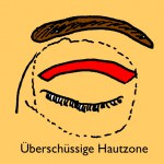 Schlupflid Entfernung