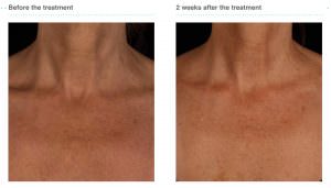 Bessere Hautqualität im Decollte nach einer Behandlung mit Juvederm Volite