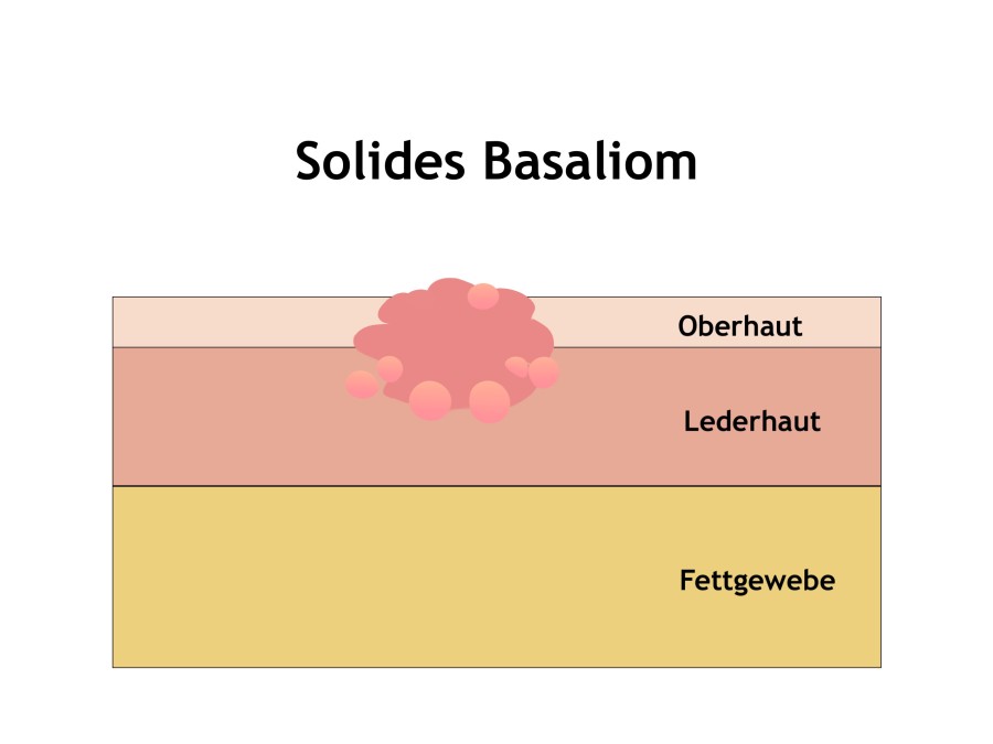 Solides Basaliom behandeln in Mainz