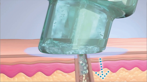 Hydrafacial Behandlung in Mainz – Fakten